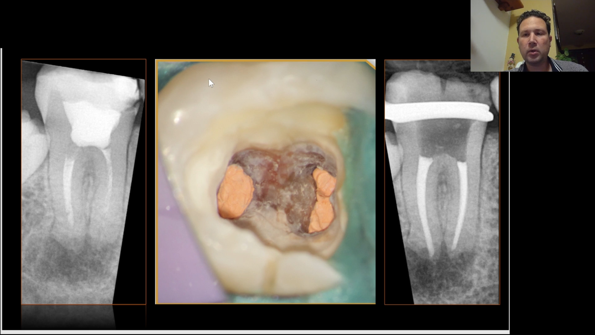 10 Benefits of Root Canal Therapy you should know 2024 - East Orange  Endodontics