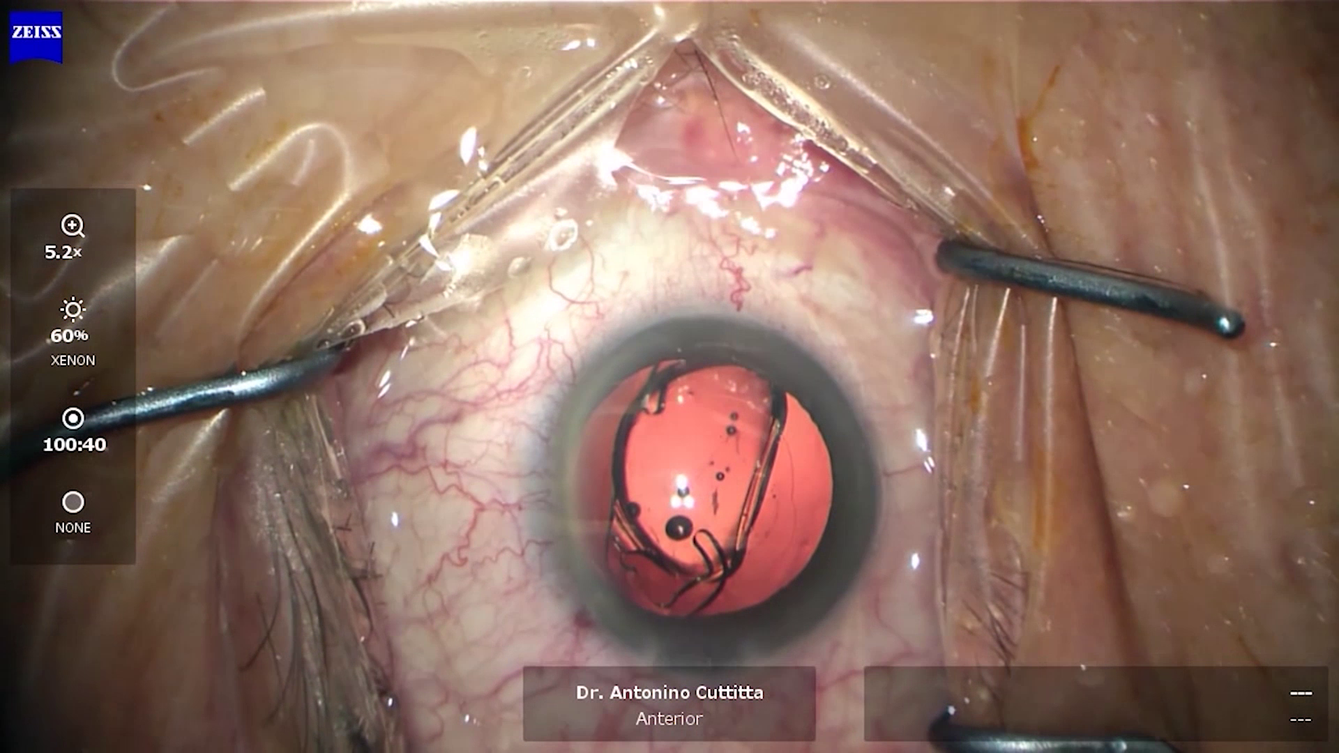 Laying the Foundation for Success in Cataract Surgery with State-of-the-Art Technology - Part 3