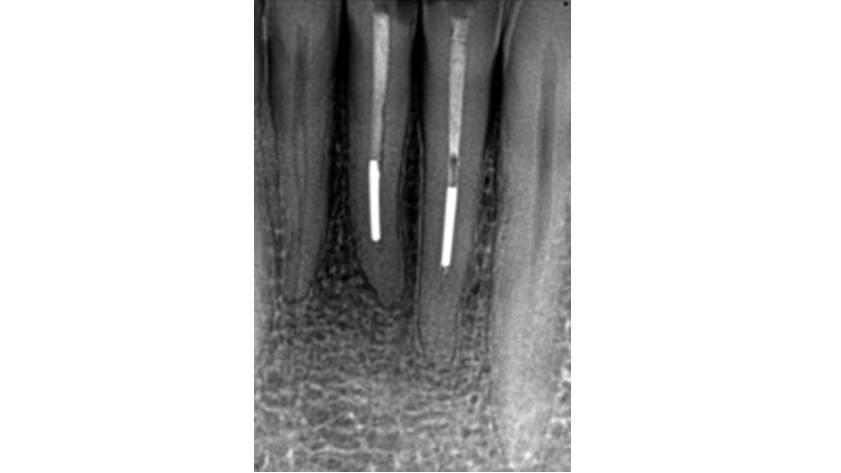Pre-operative radiograph of two lower incisors with apically placed silver point root fillings