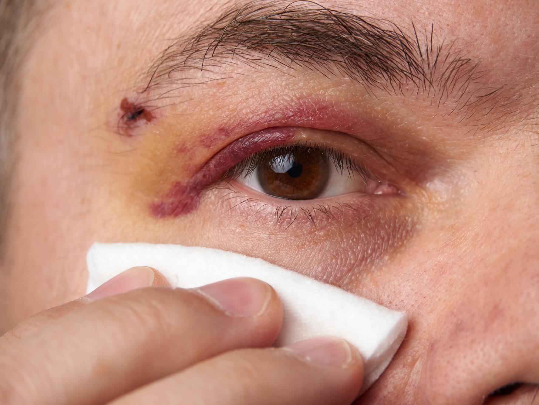 What Causes A Black Eye? - Potthoff Eye Care and Surgery